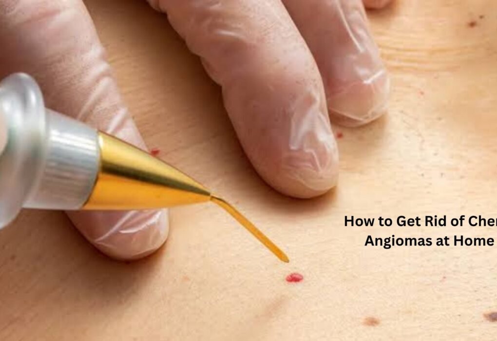 how to get rid of cherry angiomas at home