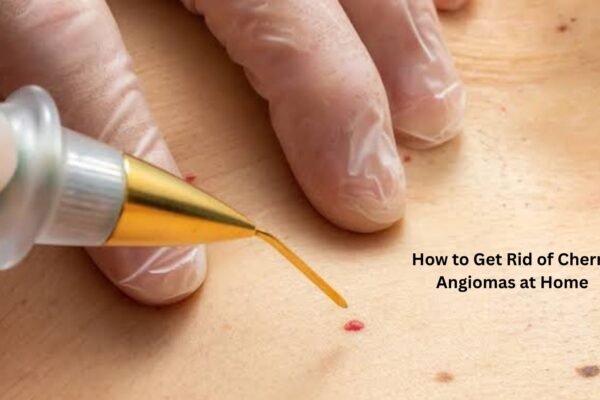 How to Get Rid of Cherry Angiomas at Home