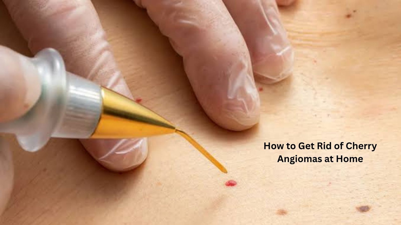 how to get rid of cherry angiomas at home