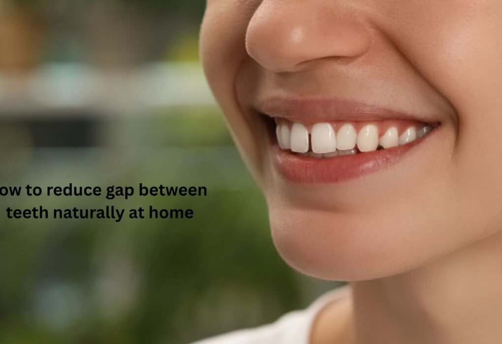 How to Reduce Gap Between Teeth Naturally at Home